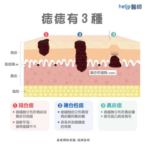 五歲長痣|痣形成的原因？痣長毛、痣變多變大是痣病變？5招判。